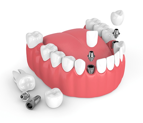 Dental Implants Kinnelon