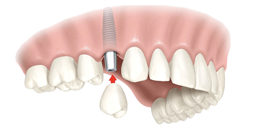 Single Dental Implants Kinnelon