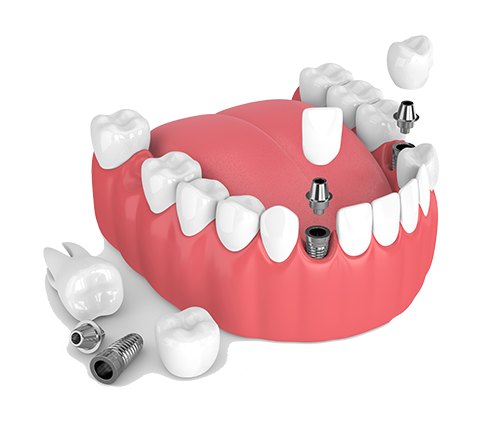 Multiple Teeth Dental Implants in Kinnelon